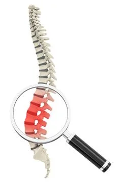Disc prolapse Stock Illustration