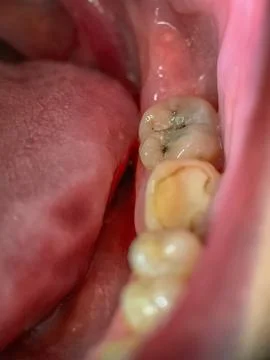 Disease of the chewing teeth Stock Photos