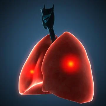 Disease illustration of human lungs. Stock Illustration