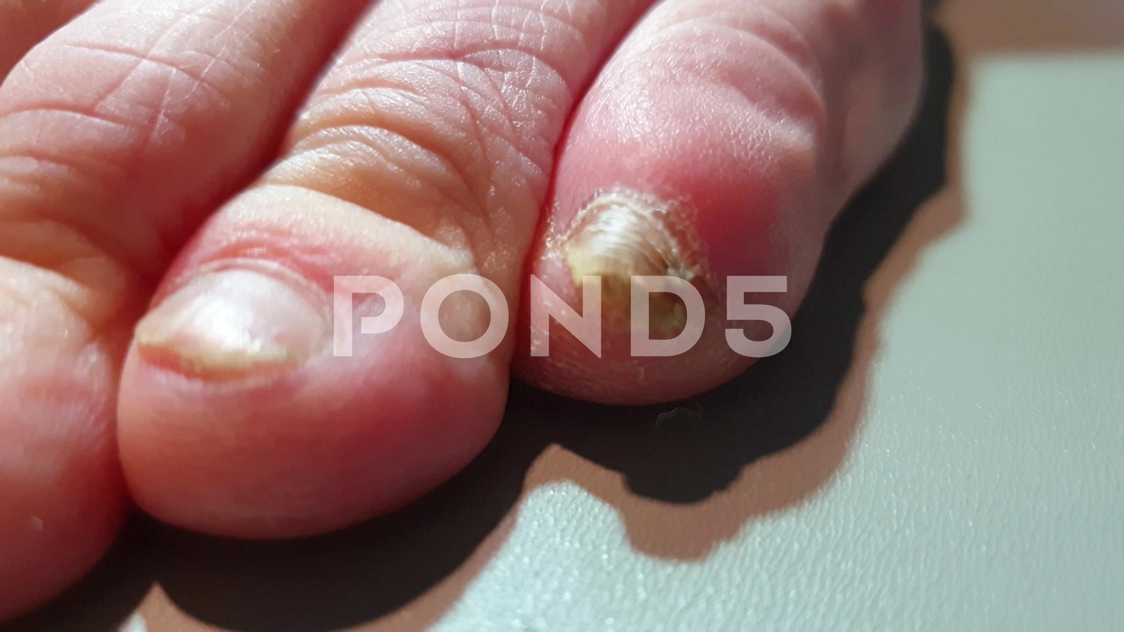 Fungal nail infection treatment - InMaricopa