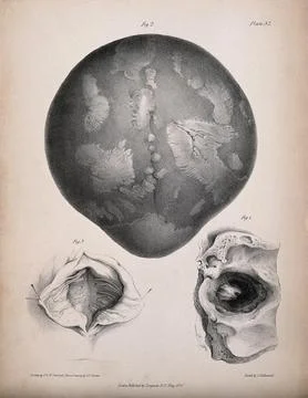 A diseased brain; and two sections of spine. Lithograph by T. &amp; W. Fairland.. Stock Illustration