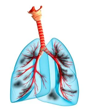Diseased lungs Stock Illustration