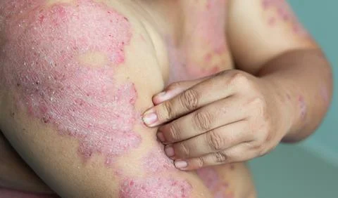 Diseases caused by abnormalities of the lymph Stock Photos