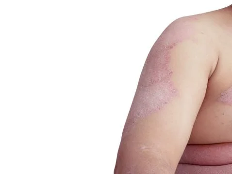 Diseases caused by abnormalities of the lymph Stock Photos
