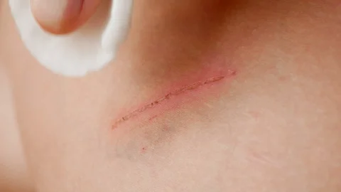 Disinfecting a wound Stock Footage 91184461
