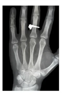 Dislocated finger Stock Photos