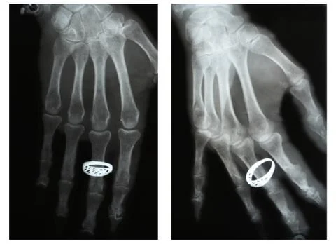 Dislocated finger,  X-ray Stock Photos