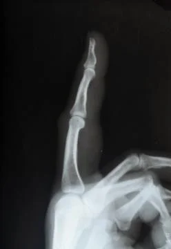 Dislocated finger, X-ray Stock Photos