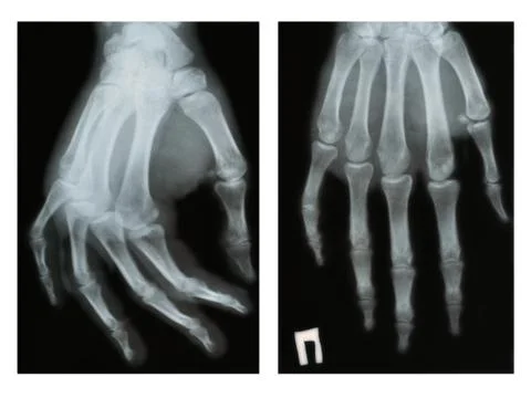 Dislocated finger,  X-ray Stock Photos