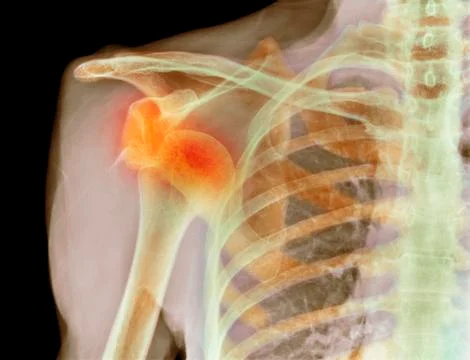 Dislocated shoulder, X-ray Stock Photos