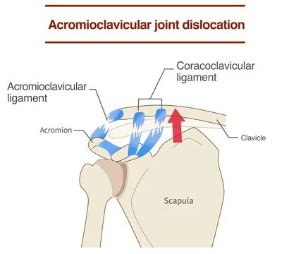 Dislocation of the acromioclavicular joint and ligaments and its mechanism Stock-Illustration
