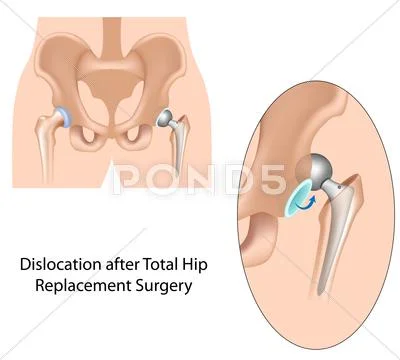 Dislocation after hip replacement surgery Stock Illustration