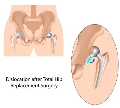 Dislocation after hip replacement surgery Stock Illustration