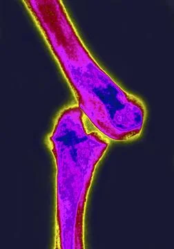  Dislocation elbow, x-ray X-ray of the arm, lateral view. Dislocation of t... Foto stock