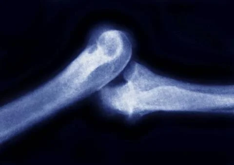  Dislocation elbow, x-ray X-ray of the arm, lateral view. Dislocation of t... Stock Photos