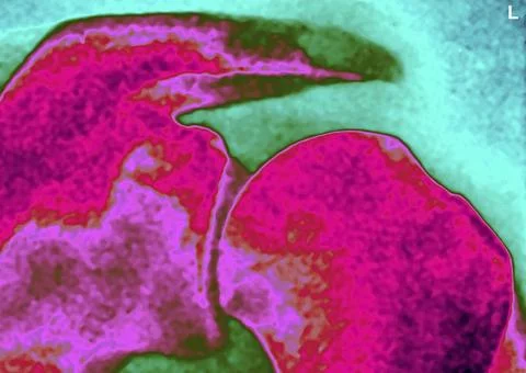  Dislocation shoulder, x-ray Dislocation of the shoulder by bone lesion. X... Stock Photos