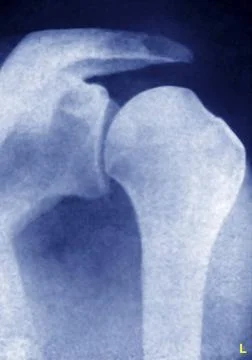  Dislocation shoulder, x-ray Dislocation of the shoulder by bone lesion. X... Stock Photos