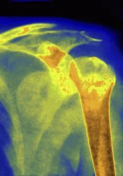  Dislocation shoulder, x-ray Dislocation of the left shoulder - X-ray of t... Stock Photos