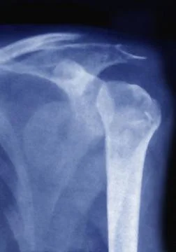  Dislocation shoulder, x-ray Dislocation of the left shoulder - X-ray of t... Stock Photos