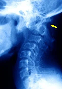  Dislocation shoulder, x-ray Paralysis by dislocation between the 1st and ... Foto stock