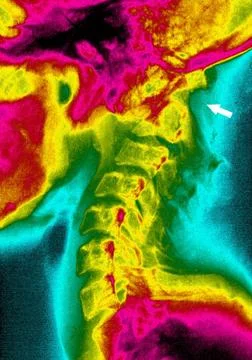  Dislocation shoulder, x-ray Paralysis by dislocation between the 1st and ... Stock Photos