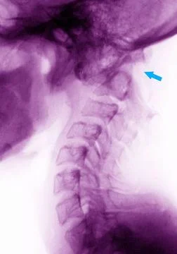  Dislocation shoulder, x-ray Paralysis by dislocation between the 1st and ... Foto stock