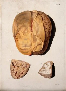 A dissected brain; and two sections of diseased brain. Coloured stipple etc.. Stock Illustration