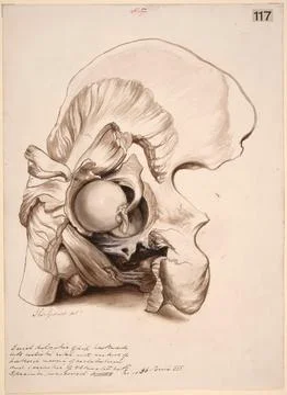 Dissected hip joint showing a recent dislocation of the femur backwards Stock Illustration