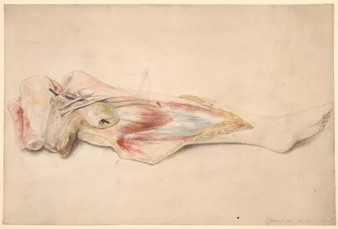 Dissected left leg with a large intermuscular cyst in the popliteal space Stock Illustration