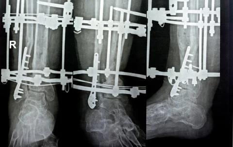 Distal comminuted fracture fibula managed by plate and screws, distal tibia.. Foto stock