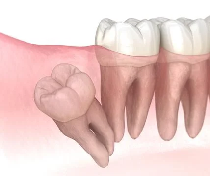 Distal impaction of Wisdom tooth. Medically accurate tooth 3D illustration Stock Illustration