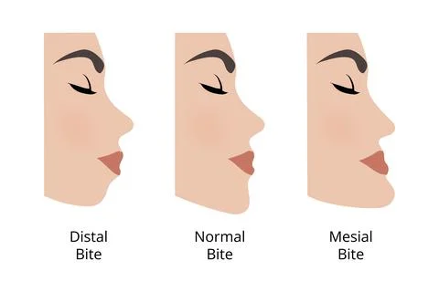 Distal, normal and mesial bite comparison Stock Illustration