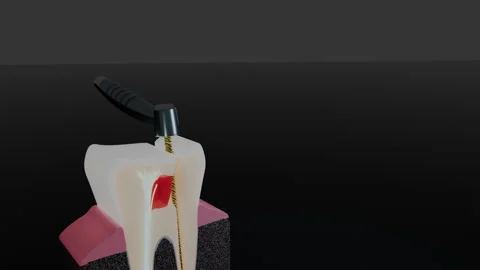 Distal root canal cleaned by endodontic file in tooth cross section, 4K Stock Footage 346121093