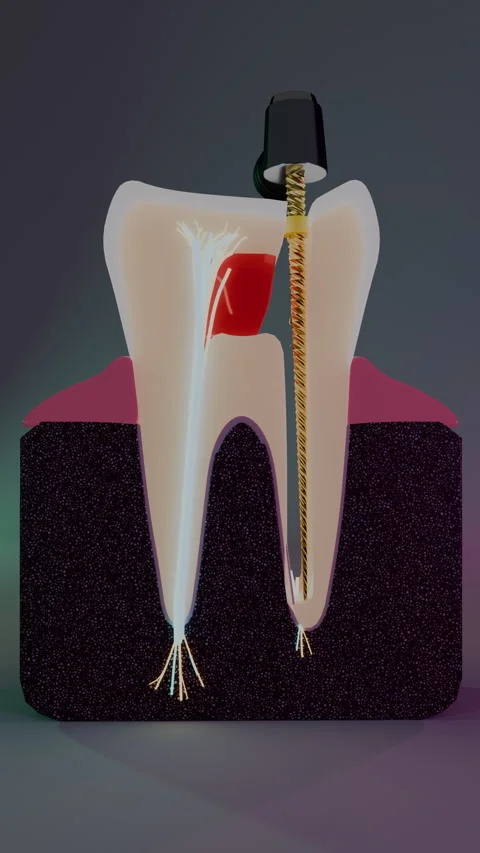 Distal root canal therapy in molar tooth cross section, Vertical 9:16 4K Stock Footage 346121630