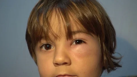 Distorted face of child after a bee bite Stock Footage 72475568