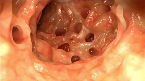 Diverticula in the colon Stock Footage 140812417