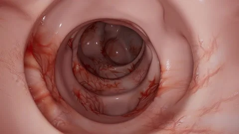 Diverticula Formation Within the Colon Video stock 235833208