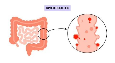 Diverticulitis and diverticulosis Stock Illustration