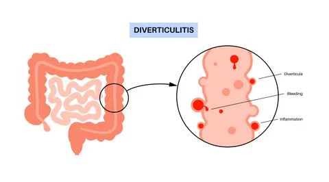 Diverticulitis and diverticulosis Illustrazione stock