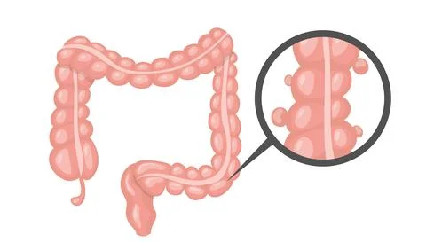 Diverticulosis affecting large intestine highlighted by magnifying glass Illustrazione stock
