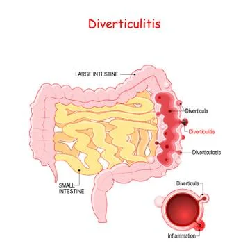 Diverticulosis and Diverticulitis Stock Illustration