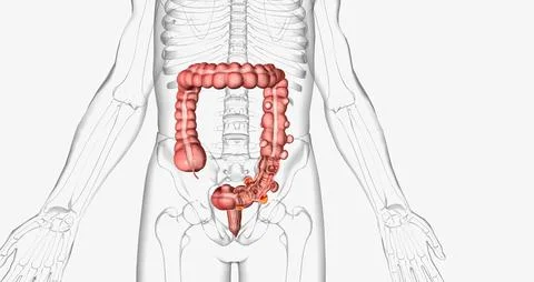 Diverticulosis occurs when small, bulging pouches develop in your digestive.. Stock Illustration