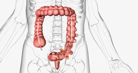 Diverticulosis occurs when small, bulging pouches develop in your digestive.. イラスト素材