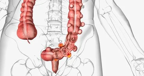 Diverticulosis occurs when small, bulging pouches develop in your digestive.. Stockillustratie