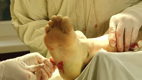 Do surgery on the foot Stock Footage 130793744
