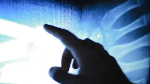 Doctor analyzing broken hand's bone after an x-ray scan Vídeo Stock 200814448