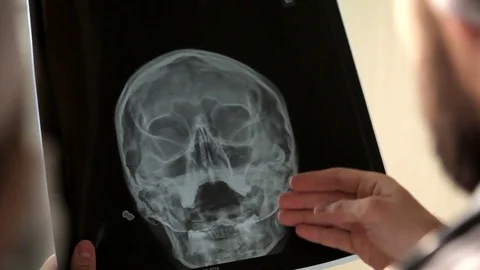 Doctor analyzing human skull x-ray screening image in hospital Video stock 72286345