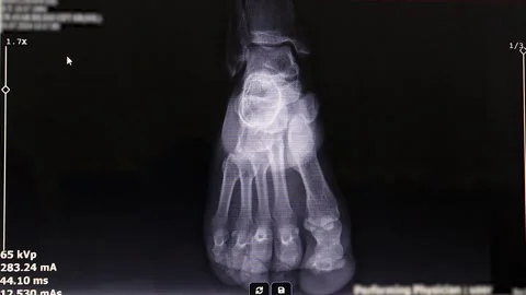 Doctor Analyzing Normal Ankle and Foot X Ray AP Lateral Oblique Views Stock Footage 325077442