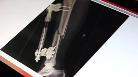 Doctor analyzing x-ray of broken bone on touch screen computer Stock Footage 59157233