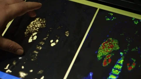 Doctor is checking body scan and metastasis of body on the touchscreen Stock Footage 100599524